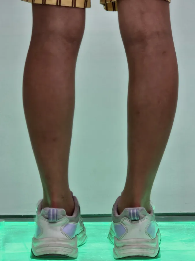 뒤꿈치 정렬 인솔 착용 후