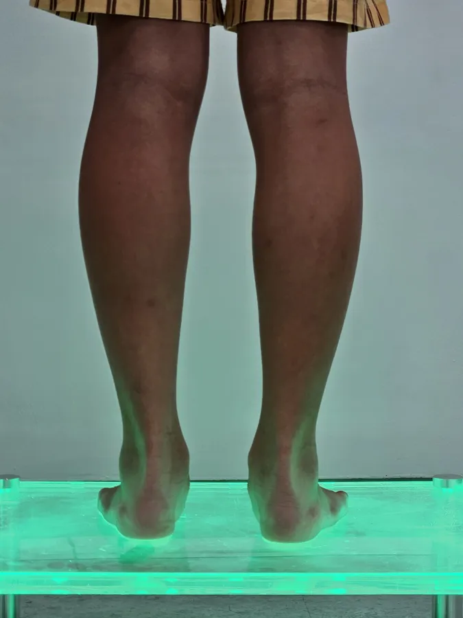 뒤꿈치 정렬 인솔 착용 전