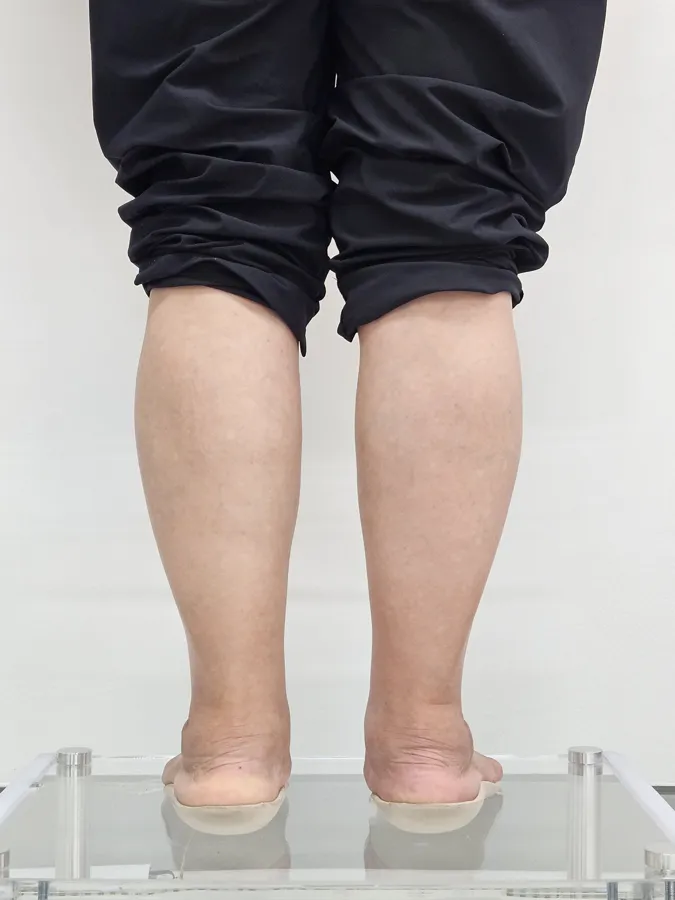 발목 라인 인솔 착용 후