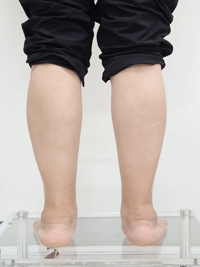 발목 라인 인솔 착용 전