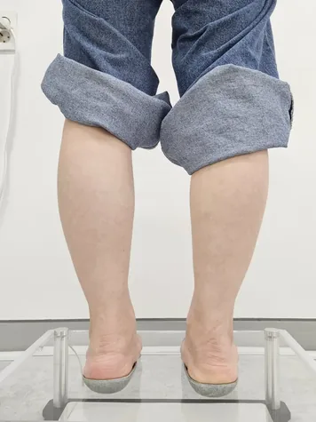 발목 정렬 인솔 착용 후